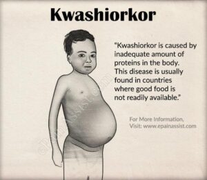 kwashiorkor